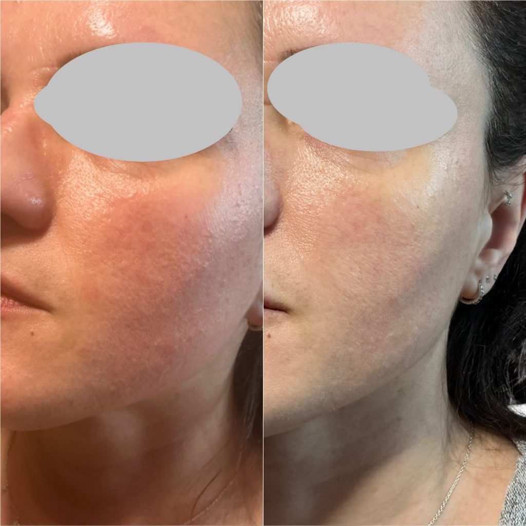 SALMON SPERM SKIN INJECTIONS