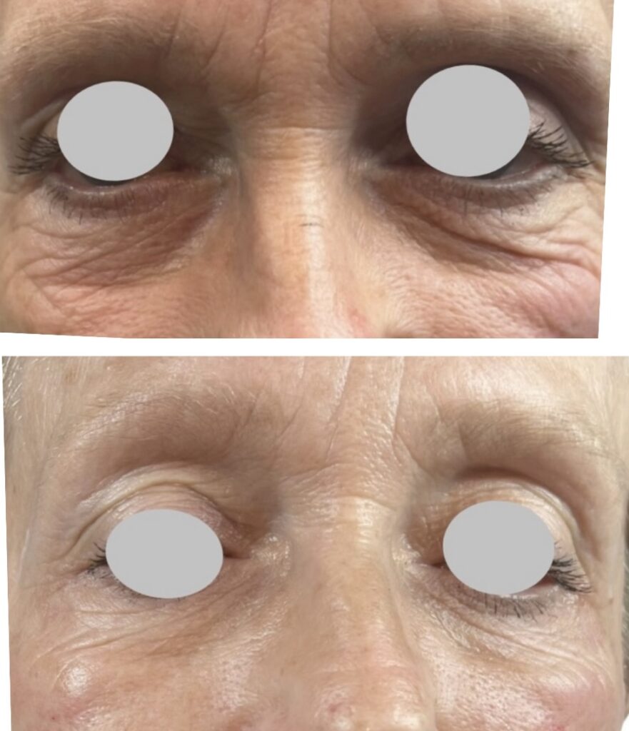 Before & after Plenhyage treatments using salmon sperm injections to improve dark circles and fine lines and wrinkles.