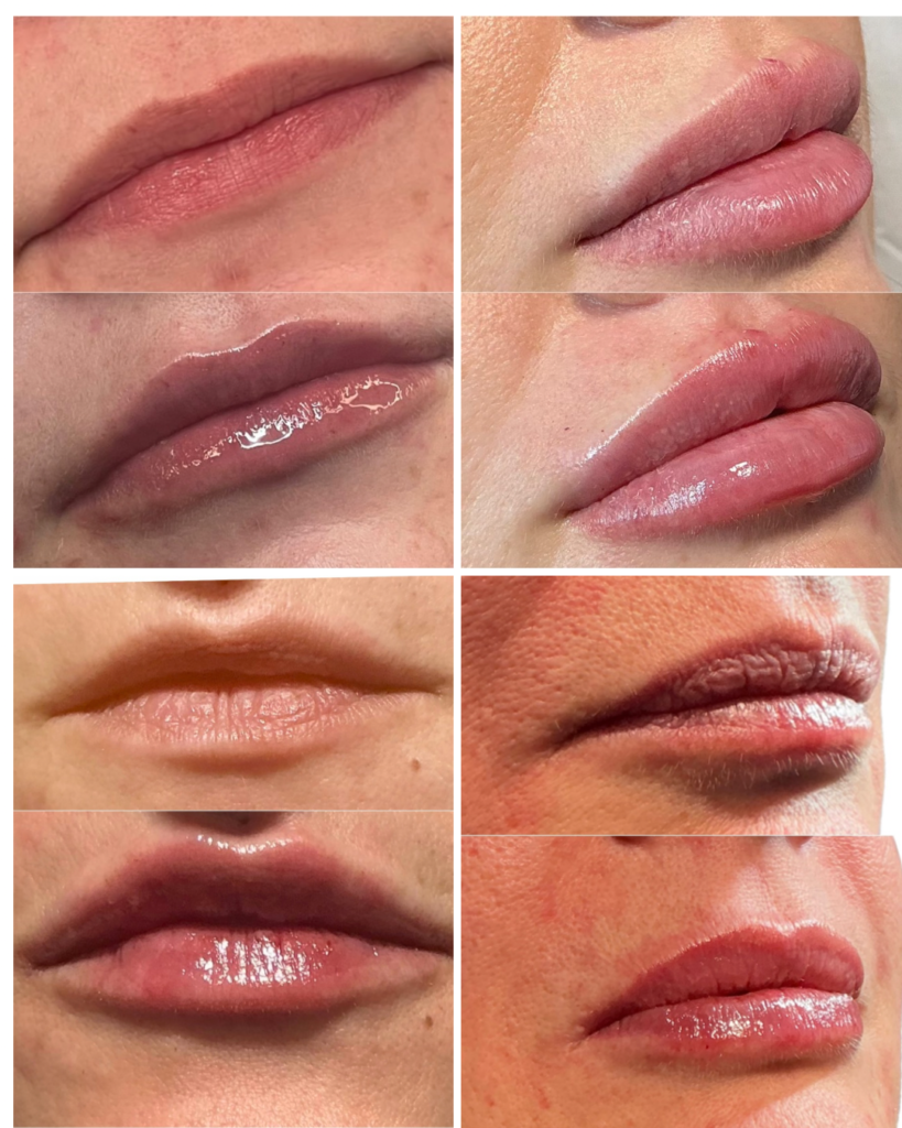 Lip filler treatment