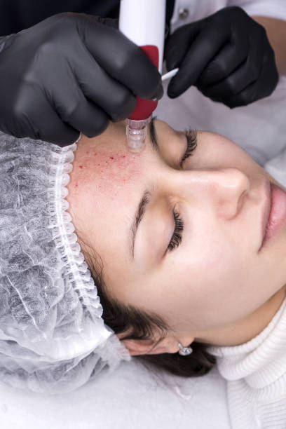 Microneedling using Exosomes