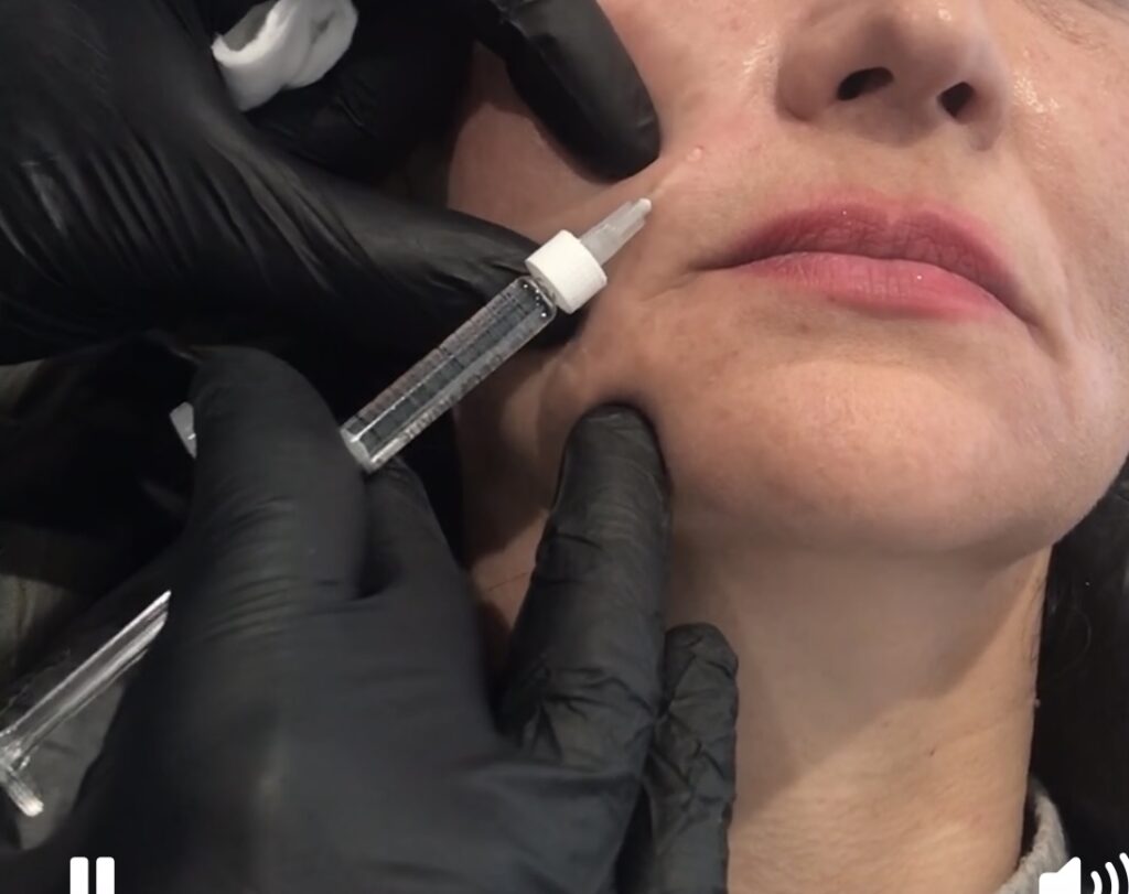Facial Filler at kiss kiss aesthetics