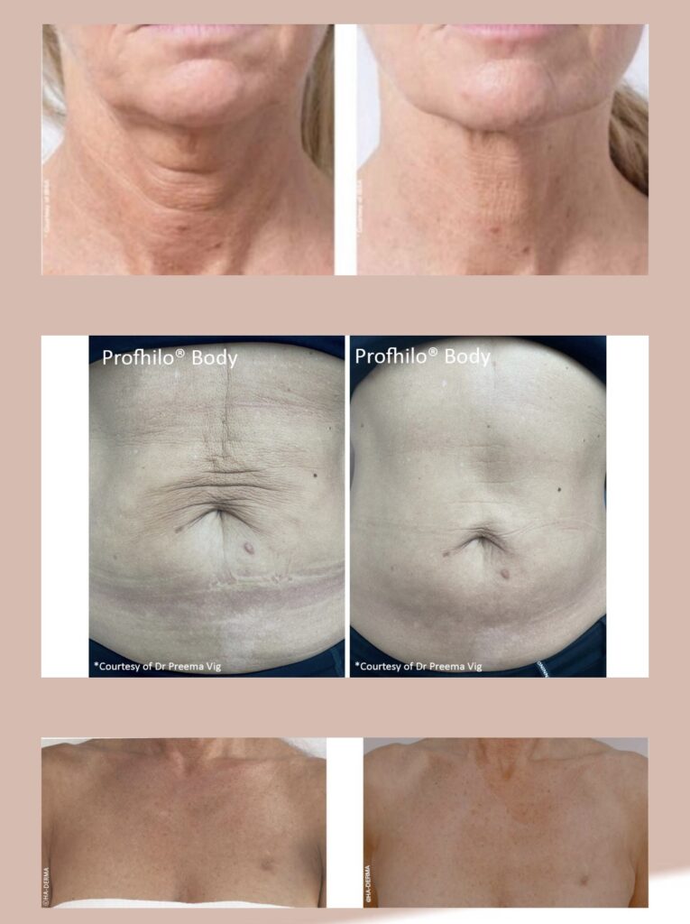 Profhilo treatment Roydon