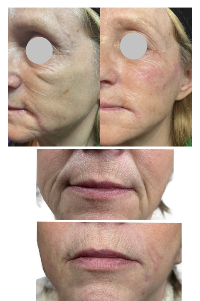 Facial Filler at kiss kiss aesthetics