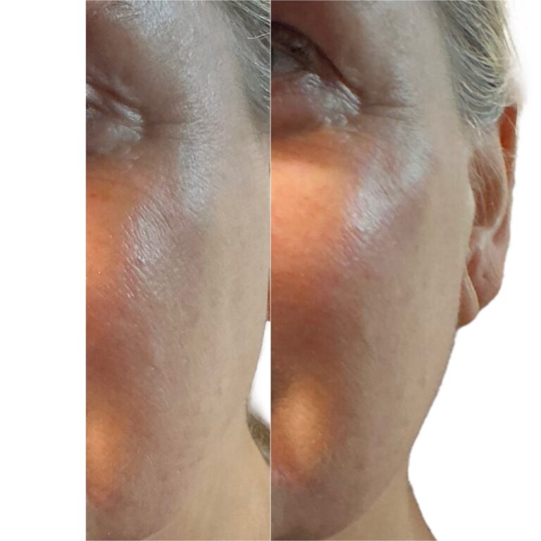 Facial Filler treatment in Roydon